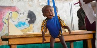 Malnourished baby.
