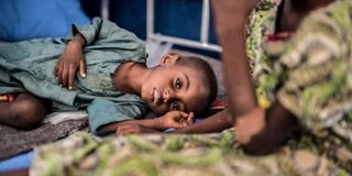 a malnutrionished child in borno state