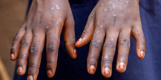 mpox hands